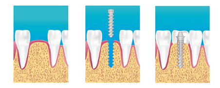 Implant dentiste  Neuilly La Defense 92