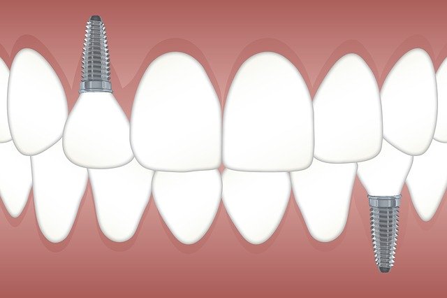 implant dentaire unitaire