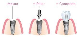 implant pilier couronne à Neuilly 92